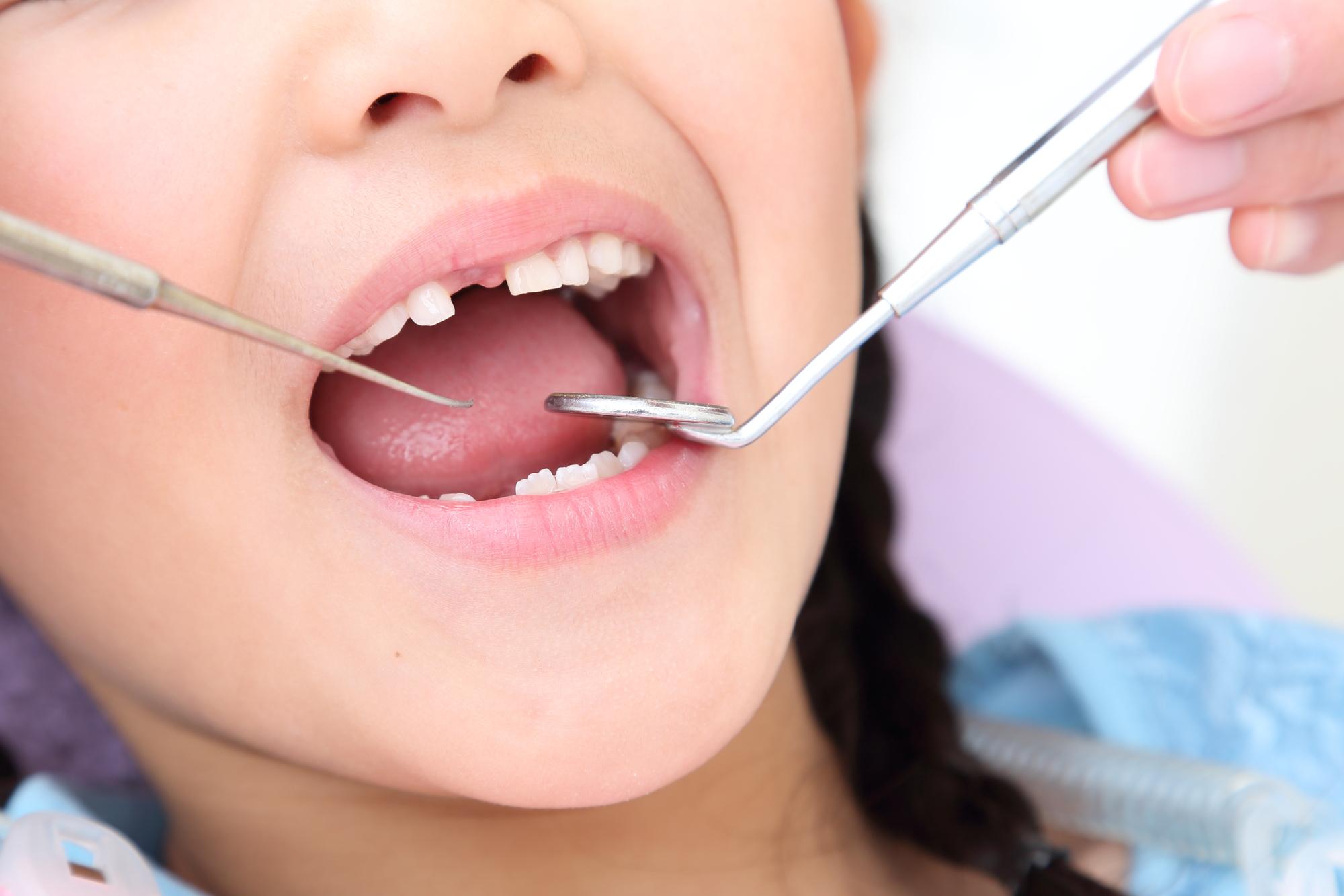 保険適用される されない 基準で異なる小児歯科の治療