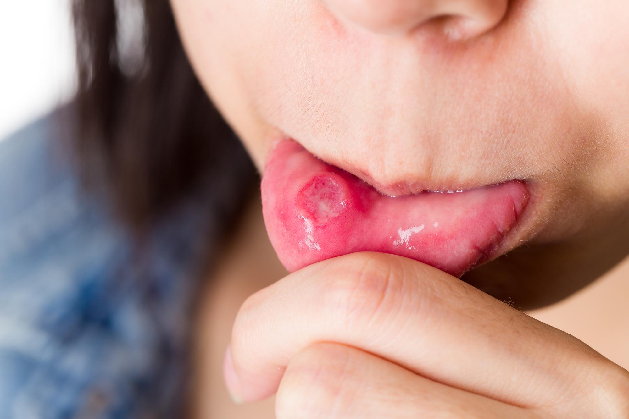 舌 でき もの 原因