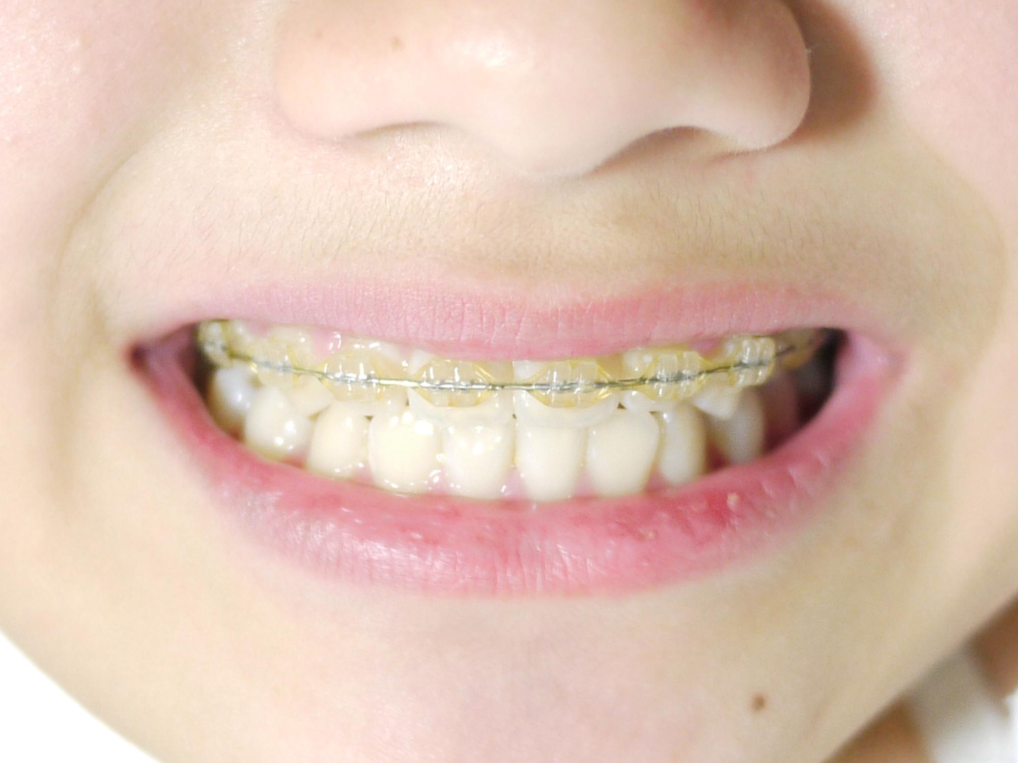 早い方がいい 子どもの歯の矯正に適した時期や治療方法について