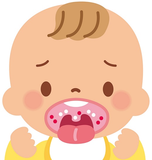 口内炎を発症した赤ちゃん